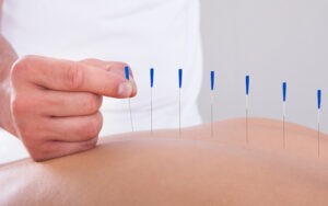 Gunn Intramuscular Stimulation