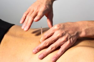 Acupuncture